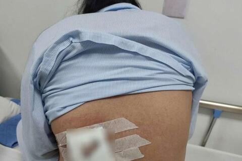 Cảnh báo đắp lá trị mụn nhọt gây hoại tử nặng