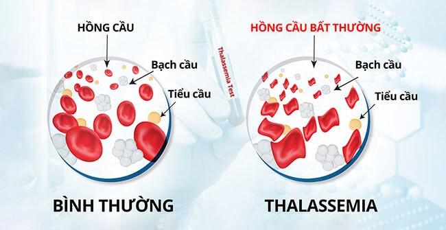 Bác sĩ khuyến cáo cách tốt nhất phòng tránh bệnh tan máu bẩm sinh ảnh 2