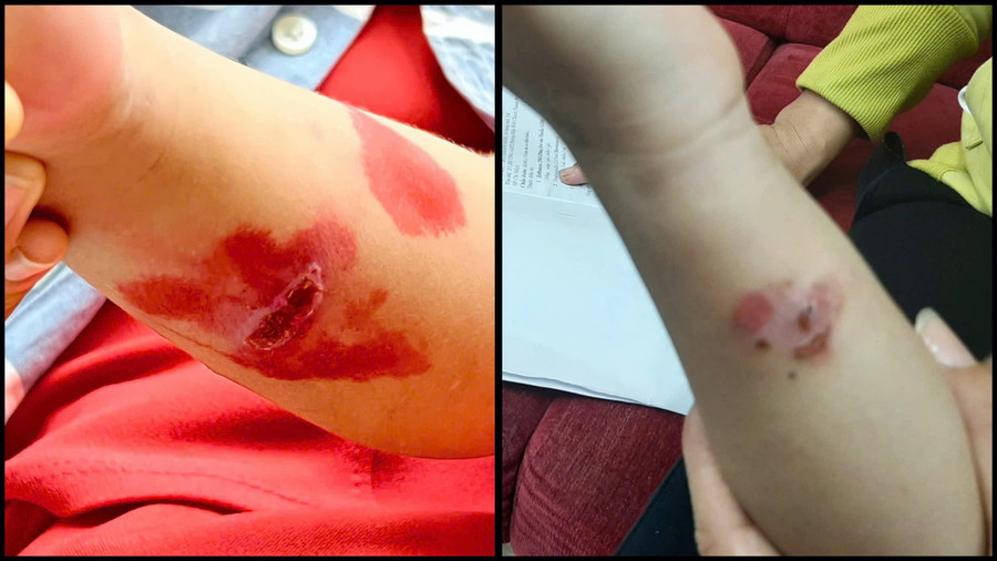 Bệnh chốc nếu chẩn đoán sớm và điều trị đúng cách sẽ khỏi nhanh và không để lại sẹo. de phong benh choc lay lan o tre (1).jpg