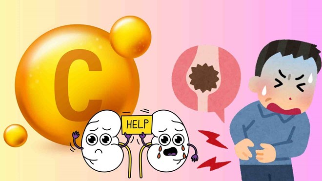 Nguyên tắc vàng khi bổ sung vitamin C để tránh nguy cơ sỏi thận