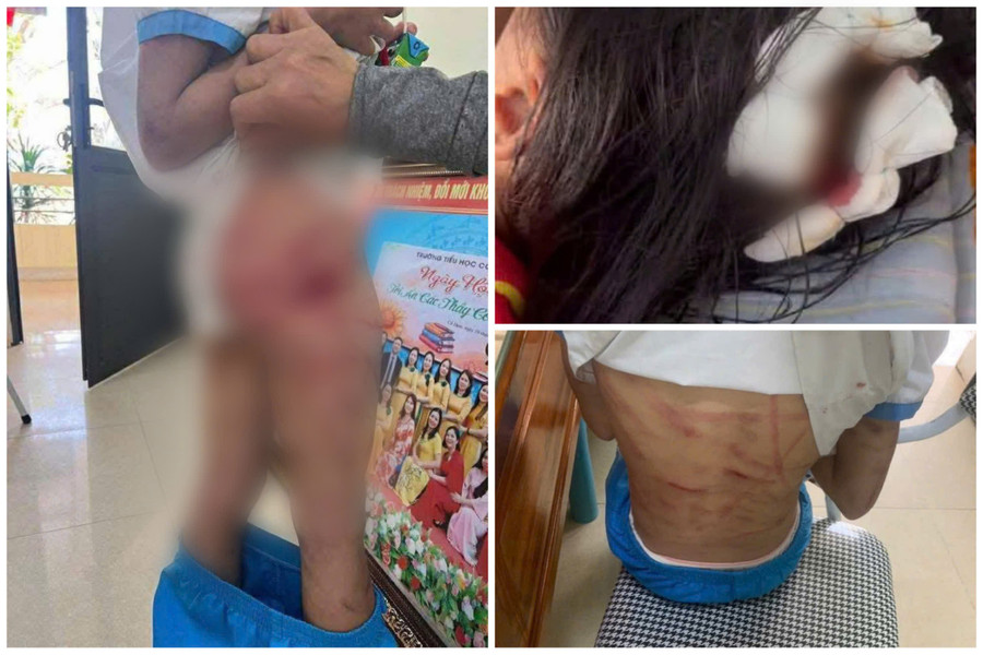 Theo lời kể của giáo viên, cháu L. đã nhiều lần bị thương tích do cha dượng đánh đập. 3d4264faf43c7962202d.jpg